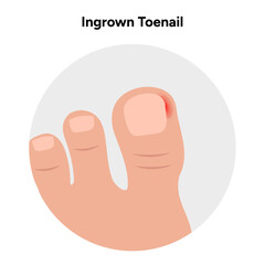 Ingrown toenail  disease or infection