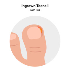 Ingrown toenail  disease or infection with pus