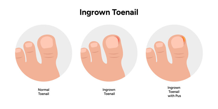 Ingrown toenail  disease or infection