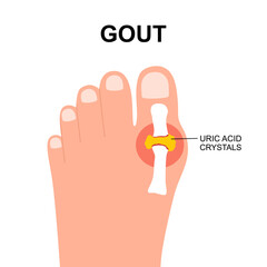 Gout arthritis with Uric acid crystals. Human foot in flat design.