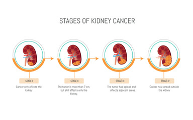 A diagram of the stages of kidney cancer. The stages are: Stage I, Stage II, Stage III, Stage IV, and Stage V