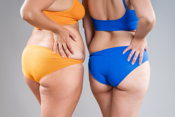 Two overweight women with cellulitis, fat flabby back, hips and buttocks on gray background, obese female body, liposuction, plastic surgery and body positive concept - 785049332