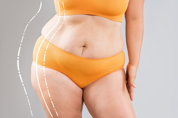 Fat woman with cellulitis, flabby belly, obesity hips and buttocks on gray background, obese female body, liposuction, plastic surgery and body positive concept with surgical lines - 785049334
