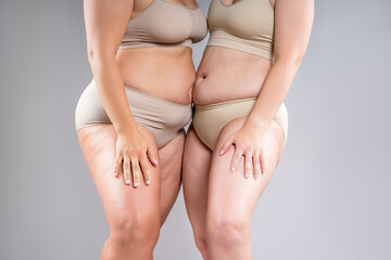 Two overweight women with cellulitis, fat flabby bellies, legs, hands, hips and buttocks on gray background, obese female body, liposuction and plastic surgery concept - 785049578
