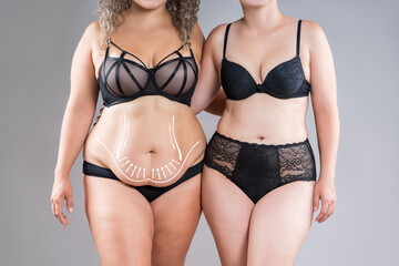 Tummy tuck, two overweight fat women with cellulitis and flabby bellies on gray background, obese...