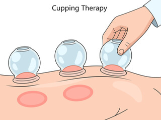 cupping therapy on skin, showcasing suction technique and resulting skin reaction diagram hand drawn schematic raster illustration. Medical science educational illustration