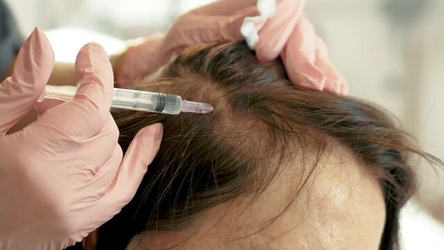 Trichologist makes injections into woman head. Treatment of problematic hair, anti baldness injection. Cosmetic procedures, filler injections and rejuvenate for aging female skin