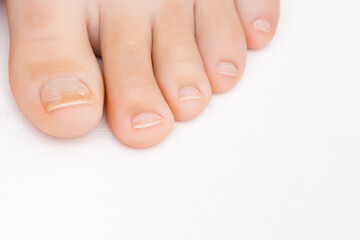 Young adult woman barefoot on white background. Dry damaged toe nails. Closeup. Front view.