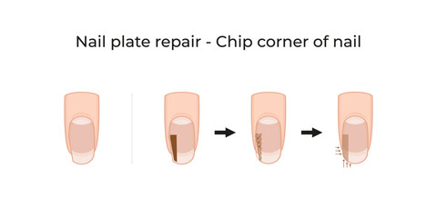 Nail plate repair - Chip corner of nail