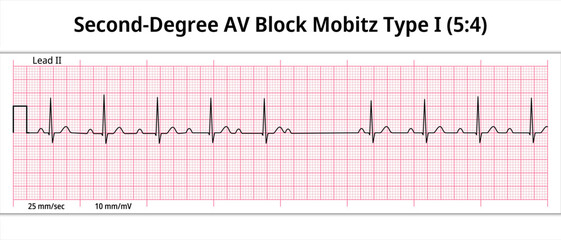 	
ECG Second Degree AV Block Mobitz Type 1 (5:4) - 8 Second Paper Electrocardiogram - Medical Vector Illustration