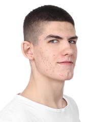 Obraz premium Young man with acne problem isolated on white