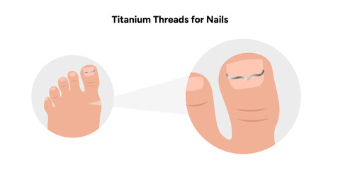 Titanium threads for nails, podiatrist 