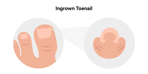 Ingrown toenail threads , podiatrist 