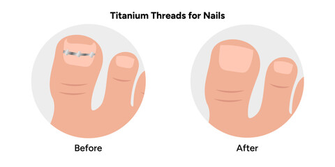 Titanium threads for nails, podiatrist 