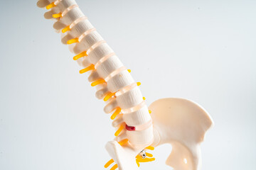 Lumbar spine displaced herniated disc fragment, spinal nerve and bone. Model for treatment medical...