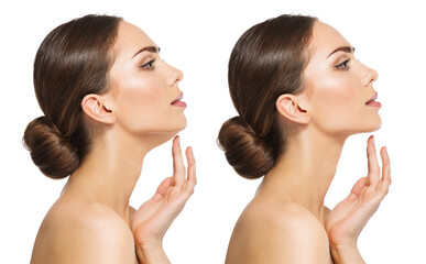 Double Chin Surgery Reduction. Women lower Jaw Before and After Plastic Surgery. Women Facelift...