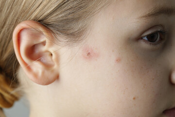 Facial skin closeup. Allergy, dermatitis, virus or bacterial infection. Dermatology,  medicine and...