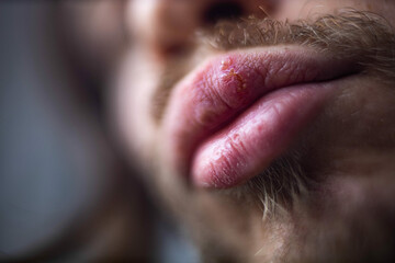 herpes on a man's lip, a viral disease on the lip	