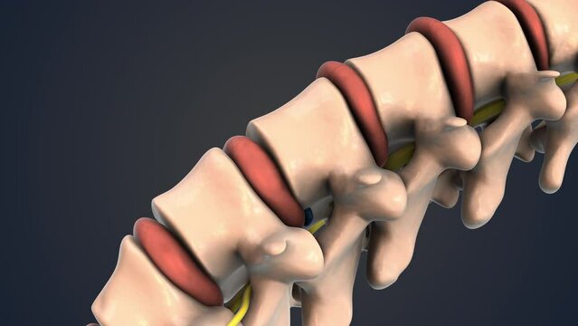 Human spine with a compressed nerve root