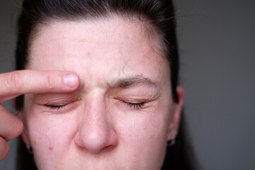 woman's face close-up. problem skin in a woman. rashes, pimples, wrinkles, redness, dark circles on a woman’s face. young woman with rashes on her face