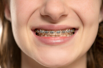 Beautiful macro shot of natural white teeth with braces. Dental care photo. Beauty woman smile with...