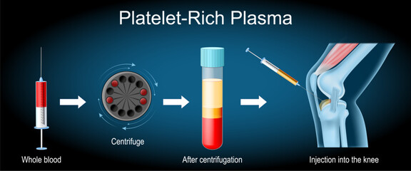 Platelet-rich plasma procedure. knee joint treatment.