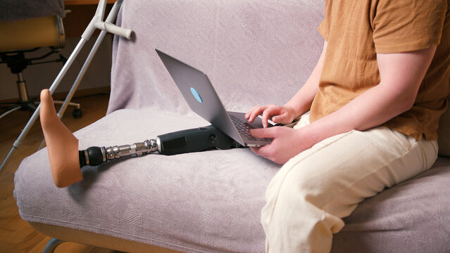 Man amputee with prosthetic leg disability on above knee transfemoral leg prosthesis artificial device using laptop at home. People with amputation disabilities everyday life
