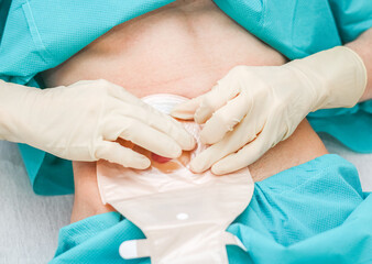 A patient in pajamas with an open abdomen, protruding intestine with a colostomy bag.