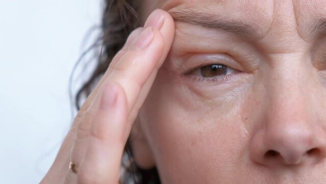 Eye allergies. Sad woman with puffy eyes. Seasonal allergies concept.
