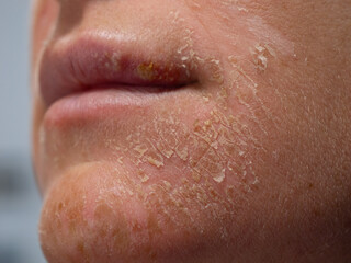 CLOSE UP, DOF: Seriously damaged epidermis of skin on the face of a young woman