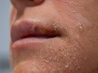 Fototapeta premium CLOSE UP, DOF: Dry and flaky facial skin of an unknown woman after sun exposure. Harmful consequences due to carelessness in summer sunbathing, which can gradually lead to development of skin cancer.