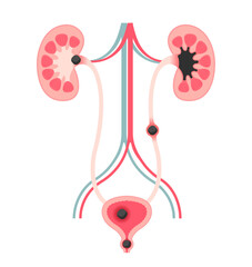 Urinary stones ( Kidney stones ) vector illustration