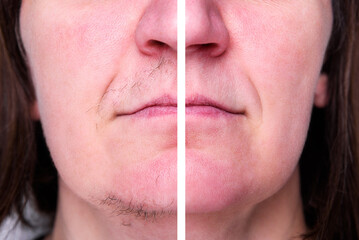 Woman's face with moustache and hairs on chin. Before and after hair removal and epilation. - obrazy, fototapety, plakaty