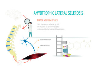 A doctor looks at a spinal column with a magnifying glass. She checks that the signal from the brain does not reach the muscle due to the disease. Amytrophic lateral sclerosis concept.