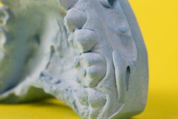 Blue plaster impression of a patient's dental jaw with crooked teeth and malocclusions on a yellow...