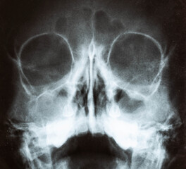 X-ray image of the skull of a child with purulent sinusitis, close-up. Treatment of inflamed...