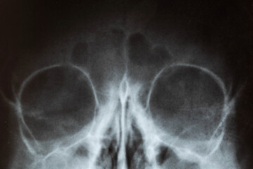 X-ray image of the skull of a child with purulent sinusitis, close-up. Treatment of inflamed...