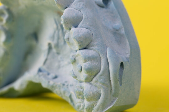 Blue plaster impression of a patient's dental jaw with crooked teeth and malocclusions on a yellow background. Manufacturing of bridges, crowns of various types, macro, arrangement of teeth