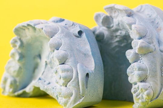 Blue plaster impression of a patient's dental jaw with crooked teeth and malocclusions on a yellow background. Manufacturing of bridges, crowns of various types, macro, arrangement of teeth