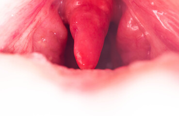 Long uvula with inflammation of infections and viruses. Treatment of uvulitis in children and...