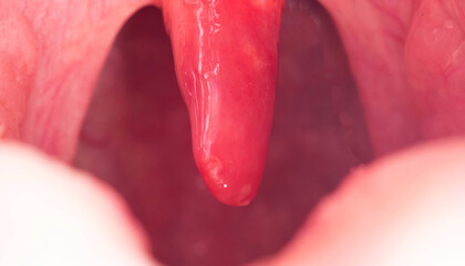 Red, inflamed and swollen uvula in the throat. Treatment of uvulitis due to bacteria and...