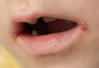 slit-like impetigo in a little girl in the corners of her mouth. Skin wounds. Dermatological...