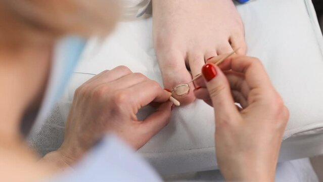 Podologist sets titanium toenail braces for woman. 