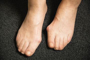 Flat feet and foot toe problems, What Problems Can Flat Feet Cause. High quality photo.  - obrazy, fototapety, plakaty
