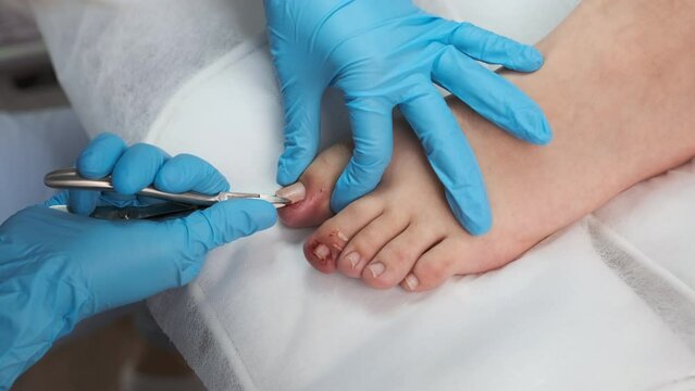 Podologist during the procedure of ingrown nail removal with clippers. 