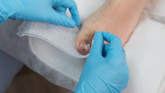 Podologist uses a bandage after applying antiseptic to the toe after removing the nail. 