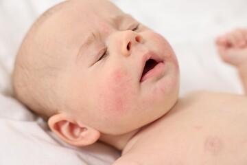 Cute little baby with allergic redness on cheeks lying on white blanket, closeup