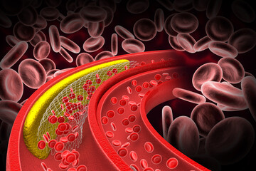 The accumulation of cholesterol in the blood vessels. Stent angioplasty. 3d illustration