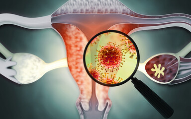 Uterus or uterine cancer. Medical concept as cancerous cells spreading in a female reproductive system. 3d illustration