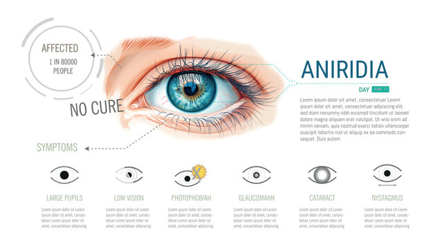 Illustration of an eye showing the absence or lack of iris, a symptom of the disease called Aniridia. On a white background some of the symptoms. Eye created with AI the rest Vector